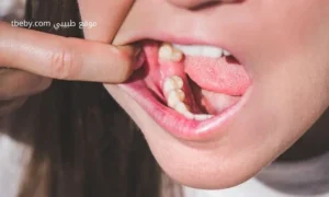 Reasons for Tooth Extraction