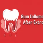 Gum Inflammation After Extraction