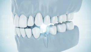 Wisdom Tooth Extraction