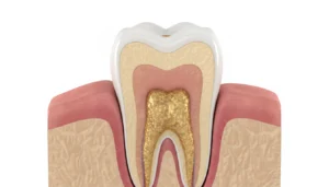What Is Gum Disease?