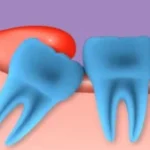 Treating an Abscessed Filled Tooth: Best Methods and Causes