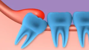 Treating an Abscessed Filled Tooth: Best Methods and Causes