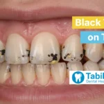 Black Tartar on Teeth – Risks, Causes & Prevention Guide 2026