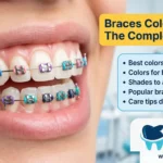 Braces Colors 2025: The Complete Guide to Choosing Your Perfect Shade