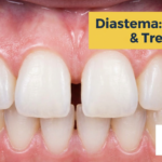 Diastema: Causes of Dental Gaps and the Best Treatment Options in 2026