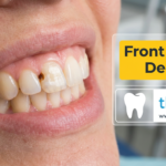 4 Most Important Treatments for Front Tooth Decay in 2026