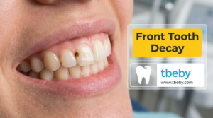 4 Most Important Treatments for Front Tooth Decay in 2026