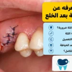 كل ما تعرفه عن خياطة اللثة بعد الخلع
