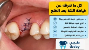 كل ما تعرفه عن خياطة اللثة بعد الخلع