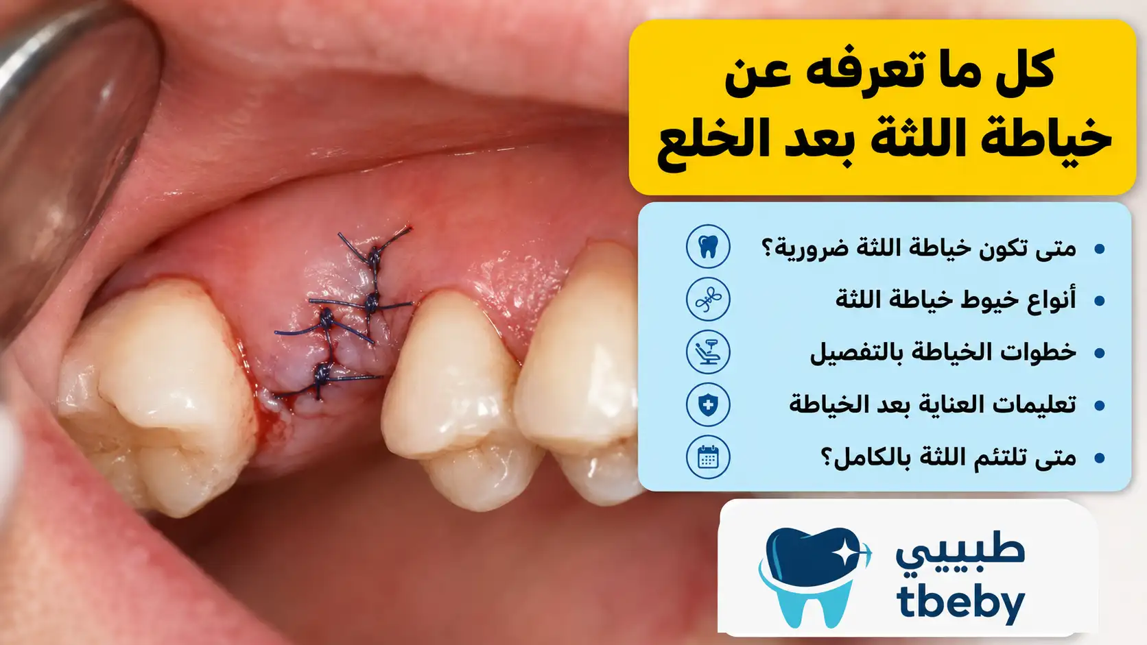كل ما تعرفه عن خياطة اللثة بعد الخلع