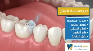 علاج حساسية الاسنان: أسباب وحلول فعّالة