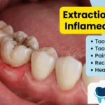 Extraction of an Inflamed Molar: Complications and Treatment Methods
