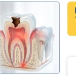 How to Kill a Tooth Nerve at Home: Safe Pain Relief