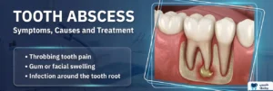 Tooth Abscess: Symptoms, Causes and Treatment