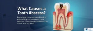 What Causes a Tooth Abscess?