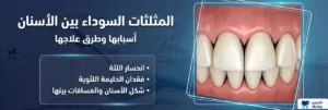 المثلثات السوداء بين الأسنان: أسبابها وطرق علاجها
