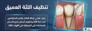 تنظيف اللثة العميق: الفوائد والخطوات والأسعار