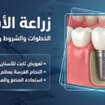 زراعة الأسنان