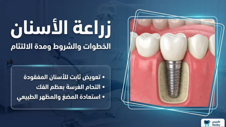 زراعة الأسنان