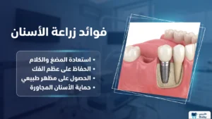 ما فوائد زراعة الأسنان؟