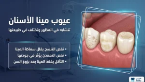ما هو الفرق بين نقص تنسج المينا وضعفها وتآكلها