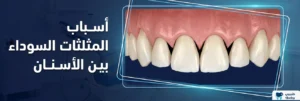 ماهي أسباب المثلثات السوداء بين الأسنان
