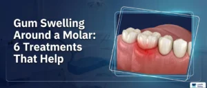 Gum Swelling Around a Molar: 6 Treatments That Help