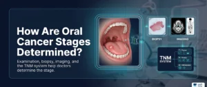 How Are Oral Cancer Stages Determined?