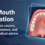 Roof of Mouth Inflammation: Causes, Relief, and Red Flags