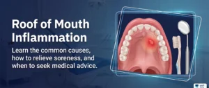 Roof of Mouth Inflammation: Causes, Relief, and Red Flags