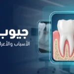 جيوب اللثة: الأسباب والأعراض وطرق العلاج