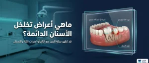 ماهي أعراض تخلخل الأسنان الدائمة؟