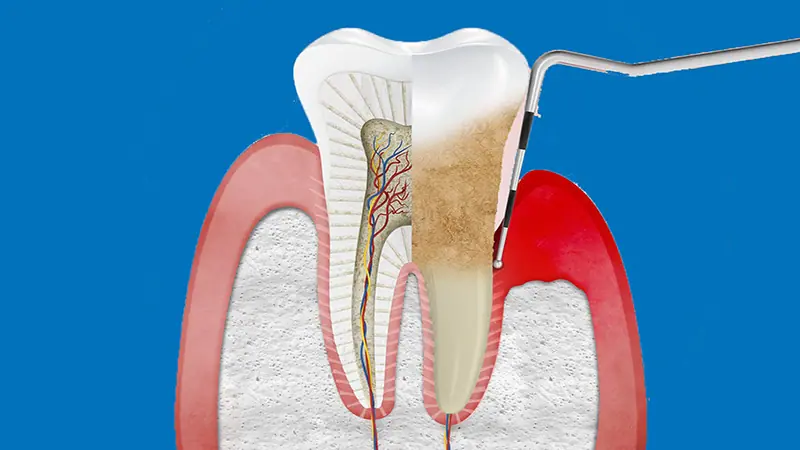 تمويت عصب الضرس بالمنزل