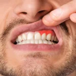 امراض اللثة