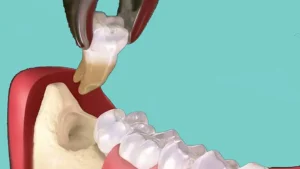 متى تلتئم اللثة بعد خلع الضرس