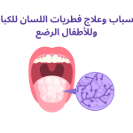 أسباب وعلاج فطريات اللسان للكبار