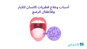 أسباب وعلاج فطريات اللسان للكبار