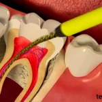 Root Canal Treatment Prices