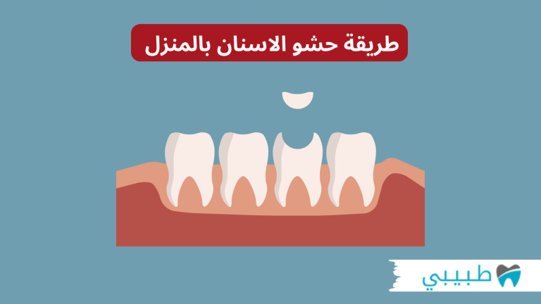 طريقة حشو الاسنان بالمنزل