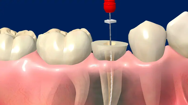 علاج عصب الضرس المكشوف