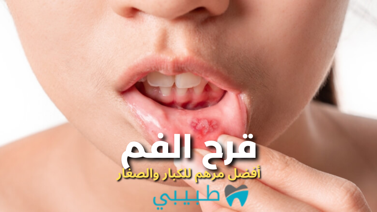 مرهم-لعلاج-قرح-الفم