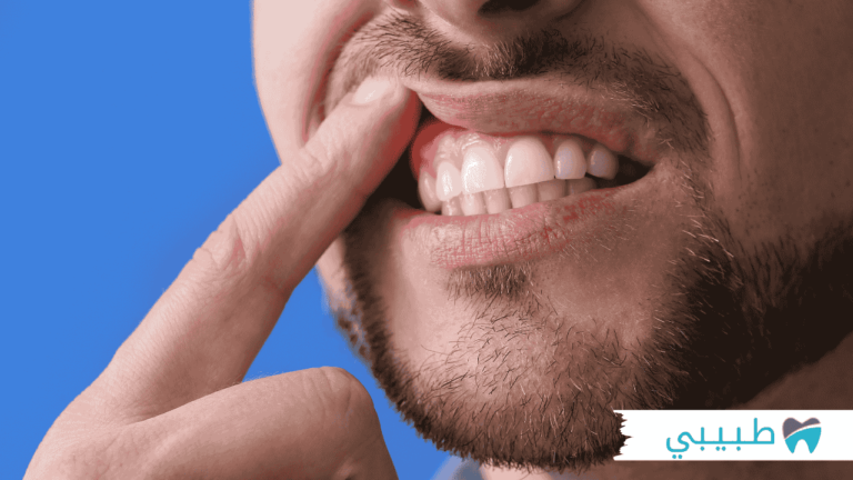 اسباب التهاب اللثة المتكرر