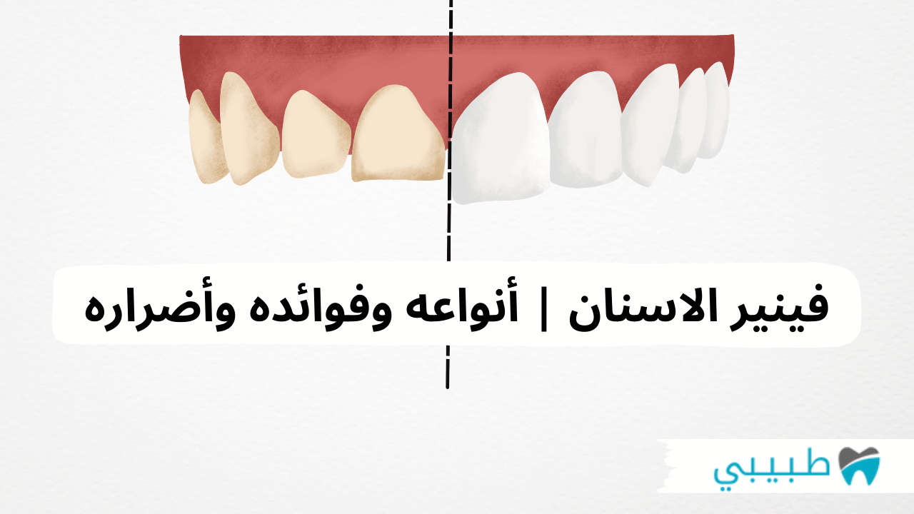 فينير للأسنان