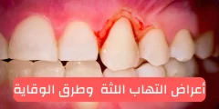 معجون أسنان لعلاج إلتهاب اللثة الحساسة