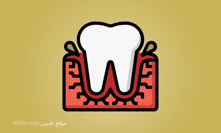 Treatment of Gum Inflammation, swollen gums