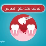 When Does Bleeding Stop After Tooth Extraction?