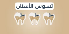 اعراض تسوس الاسنان وعلاجها
