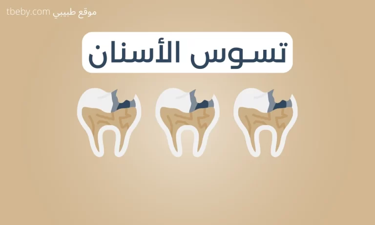 اعراض تسوس الاسنان وعلاجها 2026