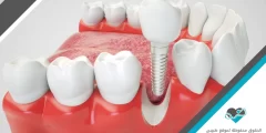 كيف تتم عملية زراعة الأسنان ؟