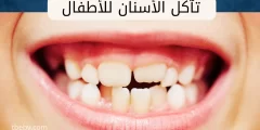 علاج تآكل الأسنان عند الأطفال سنتين